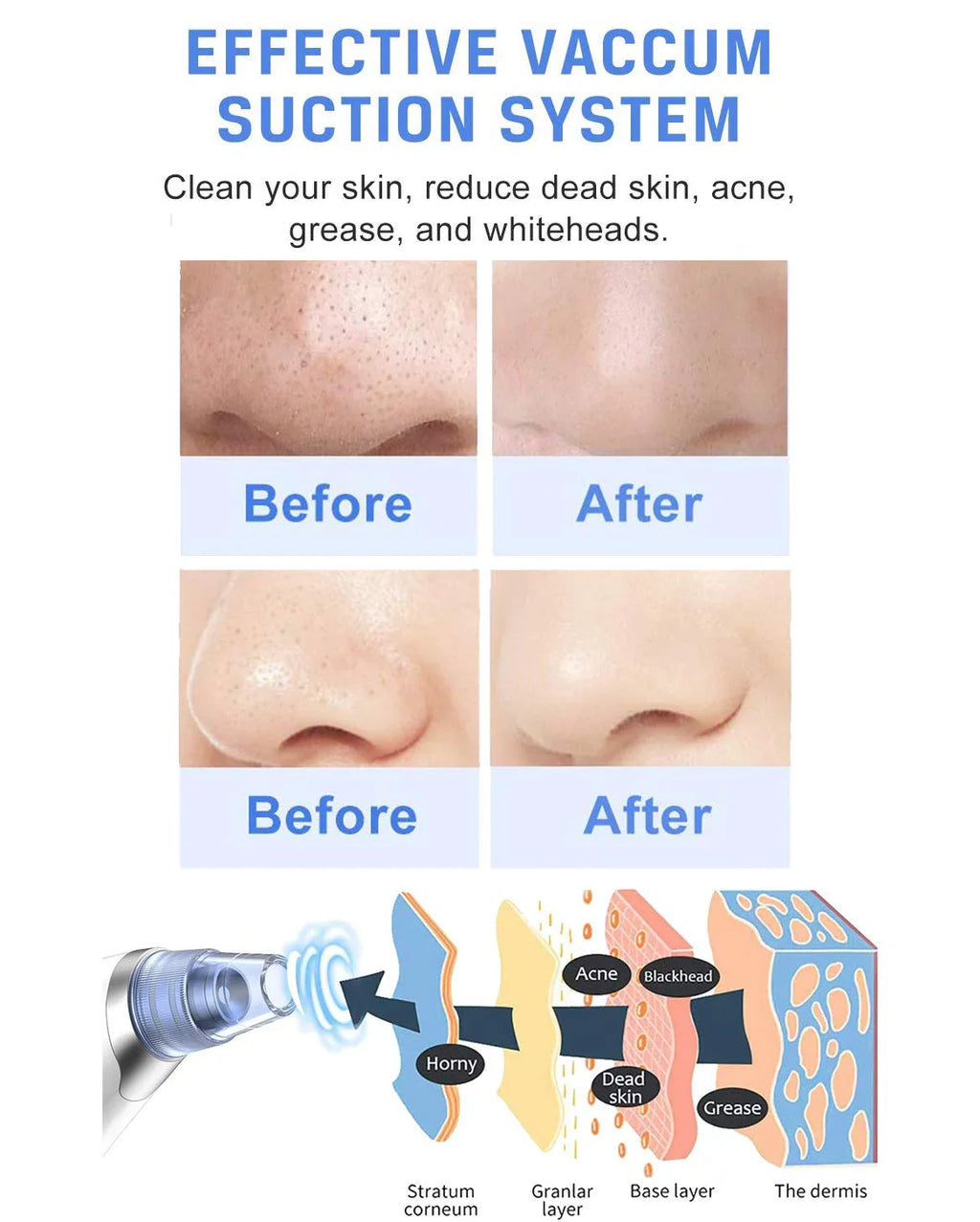 Pore Men Sucker Cleaner Women Vacuum USB Pore Blackhead Electric Remover for Face Blackhead Ansten Blackhead Cleaner Vacuum Pore Remover Rechargeable Face kit Suction Nose Pimple Facial