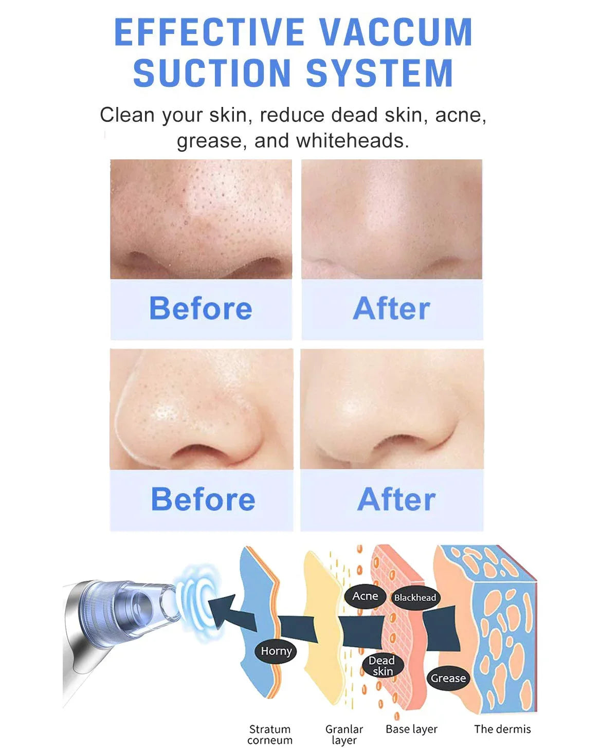 Pore Men Sucker Cleaner Women Vacuum USB Pore Blackhead Electric Remover for Face Blackhead Ansten Blackhead Cleaner Vacuum Pore Remover Rechargeable Face kit Suction Nose Pimple Facial